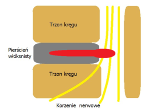 Przepuklina jądra miażdżystego