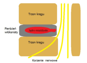 określenie rozlania jądra miażdżystego 