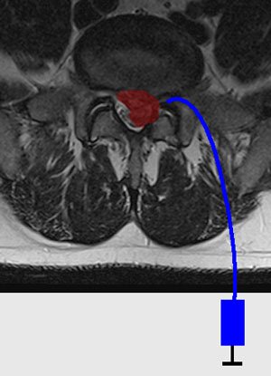 Przezotworowy zastrzyk nadtwardówkowy, leczenie rwy kulszowej, Warszawa