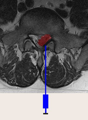 Interlaminarny zastrzyk nadtwardówkowy, leczenie rwy kulszowej, Warszawa