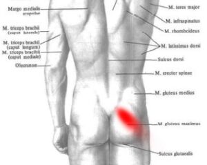 Mięsień gruszkowaty – ból w pośladku