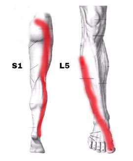 Ból nogi - objaw rwy kulszowej