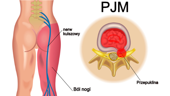 PJM w opisie rezonansu