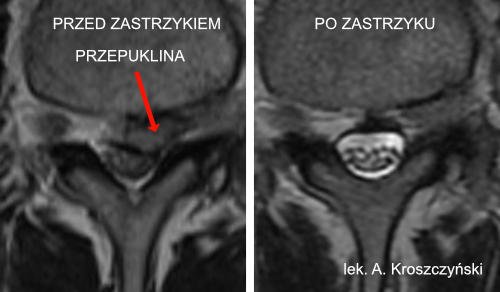 Czy przepuklina kręgosłupa może się cofnąć?