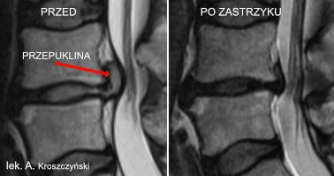 Czy przepuklina kręgosłupa może się wchłonąć?