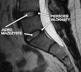 Rezonans magnetyczny kręgosłupa lędźwiowego