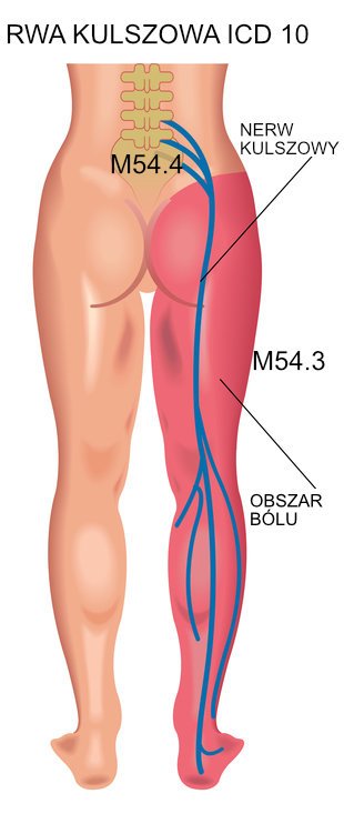 Rwa kulszowa ICD 10