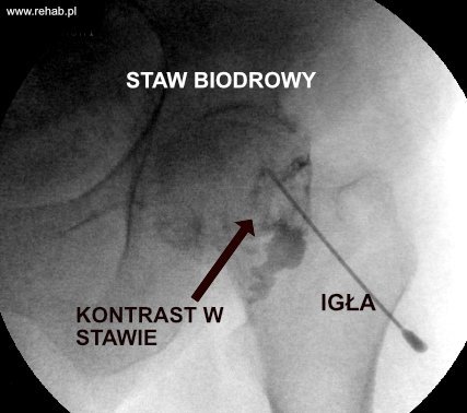 Zastrzyk do stawu biodrowego