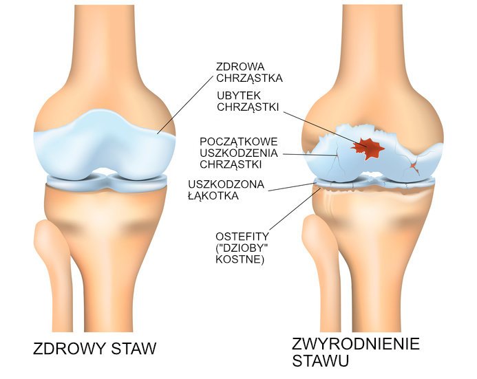 Zmiany zwyrodnieniowe stawu kolanowego