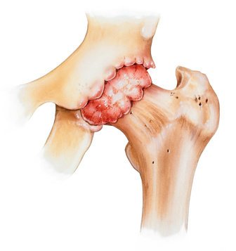 Zwyrodnienie stawu biodrowego