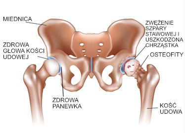 Zwyrodnienie stawu biodrowego - osteofity