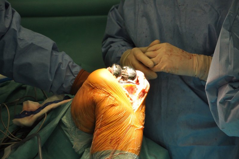 Endoproteza kolana - operacja