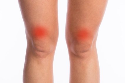 Chondromalacja rzepki - mapa bólu kolana