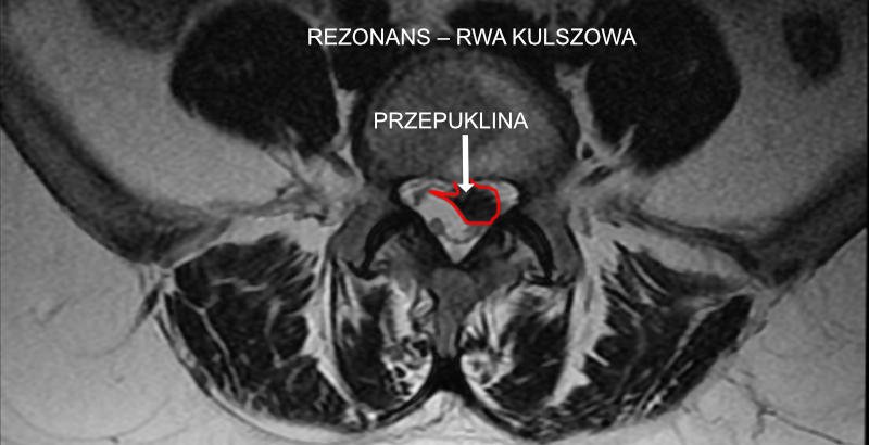 Rwa kulszowa – jaki rezonans