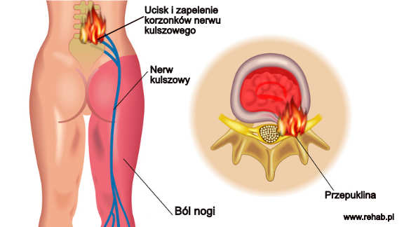 Zapalenie korzonków nerwowych