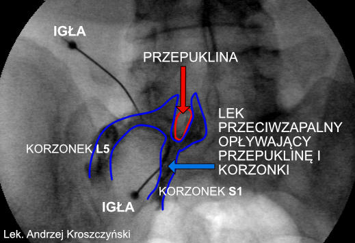 Szybkie leczenie rwy kulszowej przez skuteczne zastrzyki