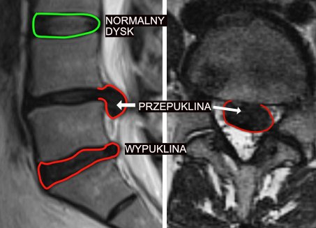 Przepuklina lędźwiowa i wypuklina krążka międzykręgowego w odcinku lędźwiowym powodują takie objawy jak ból nóg od kręgosłupa