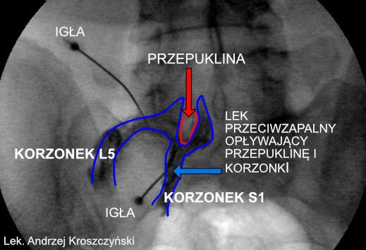 Zastrzyki na ból korzonków