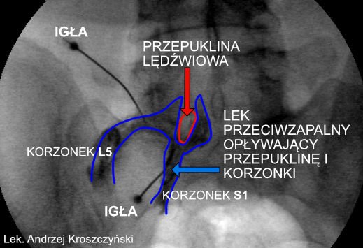 Przepuklina lędźwiowa – leczenie bezoperacyjne