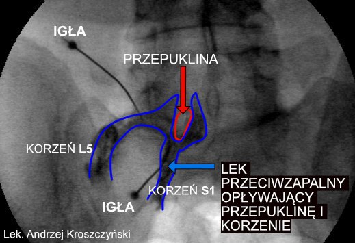 Blokada w kręgosłup 