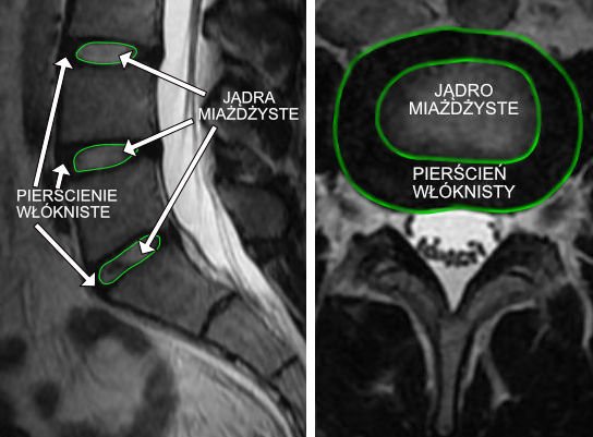 Krazek miedzykregowy kręgosłupa lędźwiowego bez cech dyskopatii