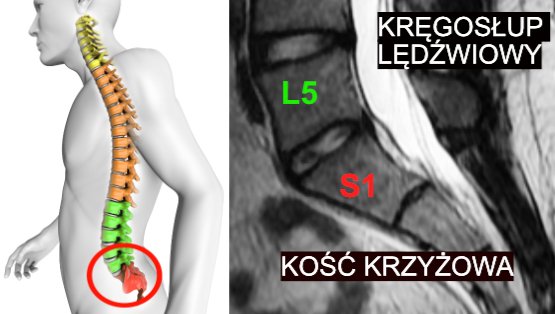 Odcinek L5 S1 kręgosłupa bez cech dyskopatii