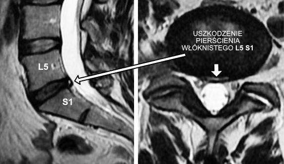 Pęknięcie pierścienia włóknistego L5 S1