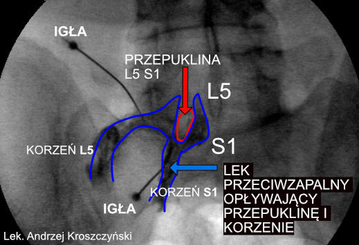 Przepuklina l5 s1 leczenie bezopoeracyjne