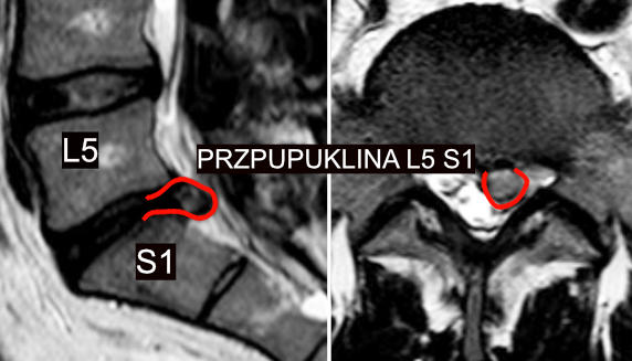 Przepuklina l5s1 rezonans magnetyczny 