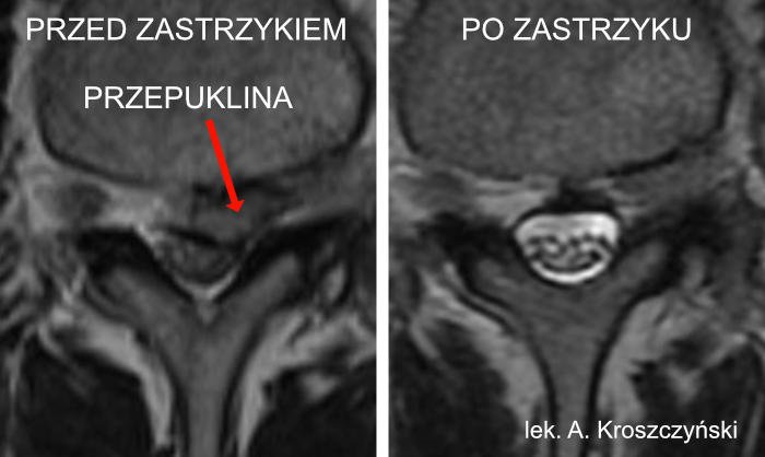 Rwa kulszowa - zastrzyki, blokada kręgosłupa lędźwiowego