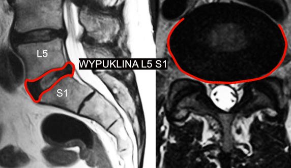 Wypuklina l5 s1 w rezonansie magnetycznym