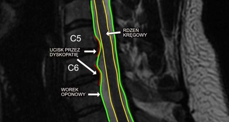 Protruzja Tarczy Międzykręgowej Co To Jest rehab.pl