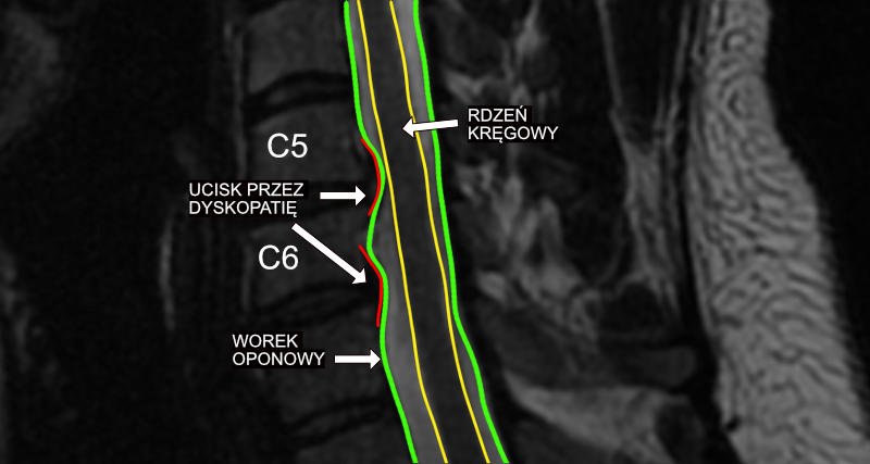 Ucisk na worek oponowy – czy to groźne?