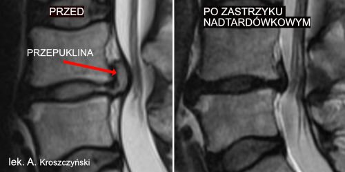Przepuklina Kregoslupa Leczenie Bezoperacyjne Lekarz Od Kregoslupa Warszawa Andrzej Kroszczynski
