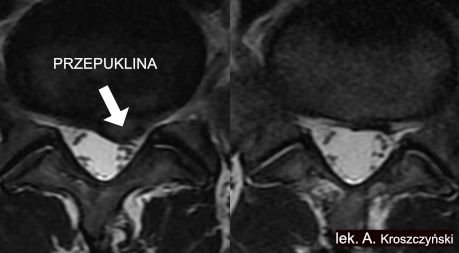 Czy można wyleczyć przepuklinę kręgosłupa bez operacji?