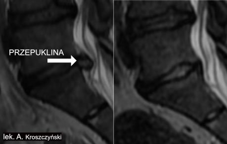 Przepuklina Kregoslupa Leczenie Bezoperacyjne Lekarz Od Kregoslupa Warszawa Andrzej Kroszczynski