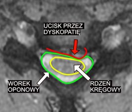 Protruzja krążka międzykręgowego z uciskiem worka oponowego