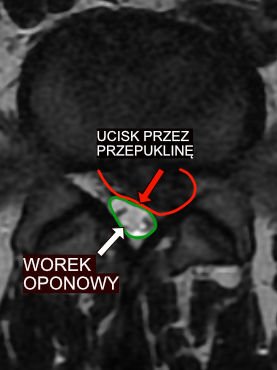 Przepuklina krążka międzykręgowego uciskająca worek oponowy kręgosłupa lędźwiowego