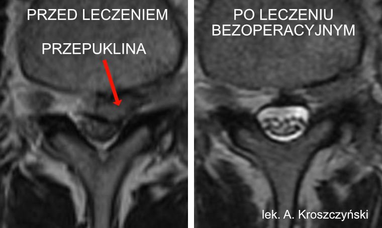 Przepuklina Kregoslupa Leczenie Bezoperacyjne Lekarz Od Kregoslupa Warszawa Andrzej Kroszczynski