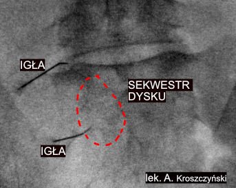 Sekwestracja krążka międzykręgowego – bezoperacyjne leczenie sekwestru