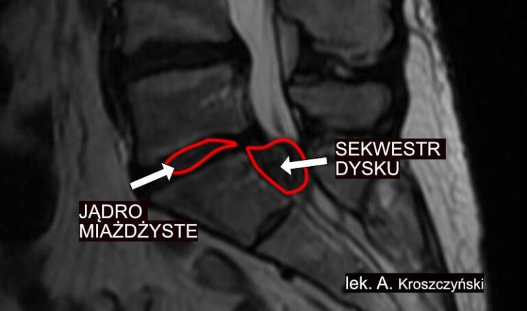 Sekwestracja krążka międzykręgowego (dysku) Lekarz od kręgosłupa