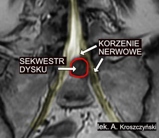 Sekwestracja dysku L5 S1, sekwestr uciska korzenie