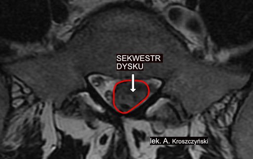 Sekwestracja krążka międzykręgowego