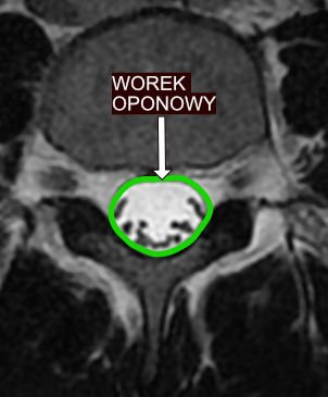 Worek oponowy kręgosłupa lędźwiowego