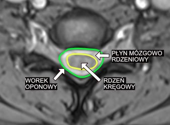 Worek oponowy w kręgosłupie szyjnym