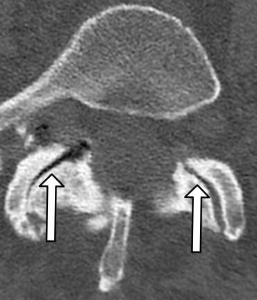 Choroba zwyrodnieniowa kręgosłupa – spondyloartroza
