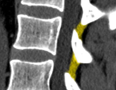 Normalne więzadła żółte w tomografii komputerowej