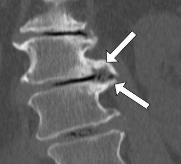 Osteofity na krawędziach trzonów kręgów