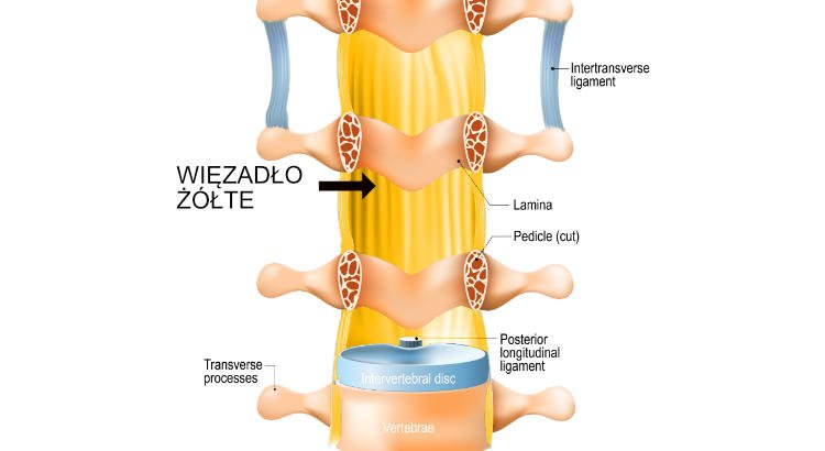 Pogrubienie więzadeł żółtych w kręgosłupie