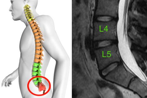 Poziom L4 L5 kręgosłupa bez cech dyskopatii